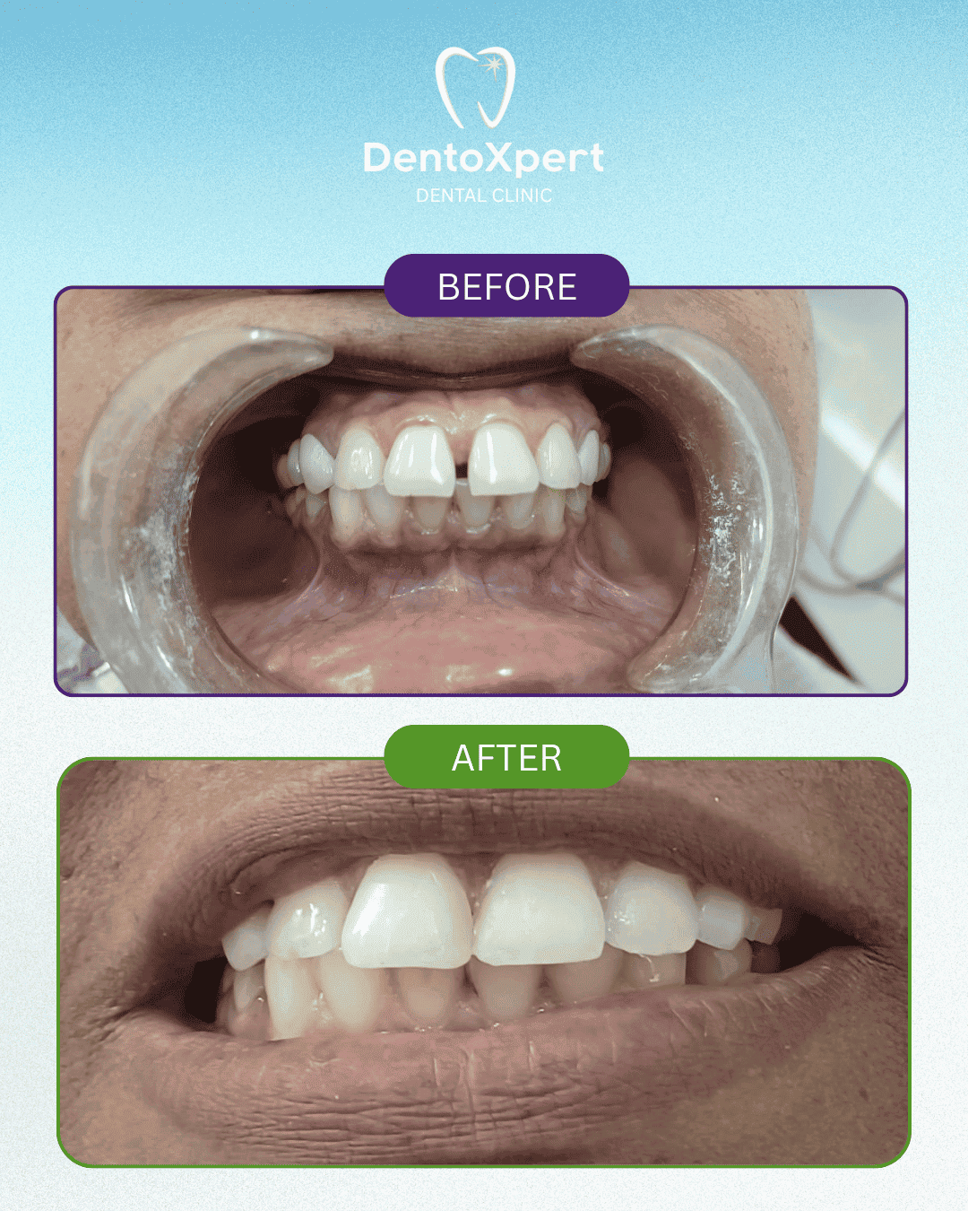 Before and after dental treatment result at DentoXpert Dental Clinic in Thane
